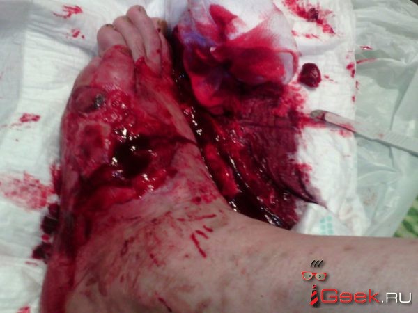 После травмы серовчанин Андрей Шатов лишился ноги. Родственники мужчины винят в произошедшем врачей
